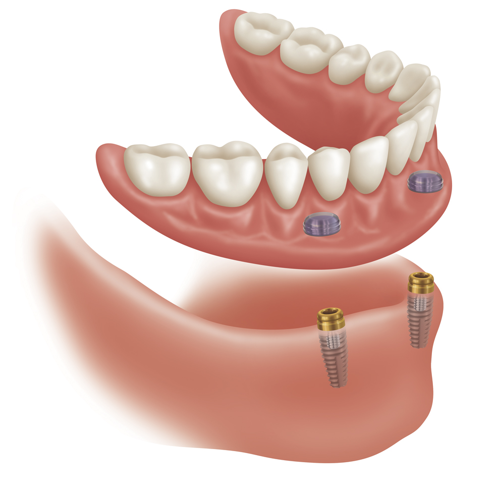 implantes dentales menorca