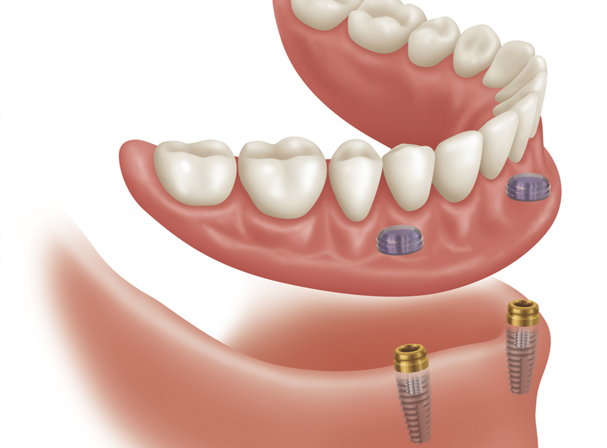 implantes dentales en menorca